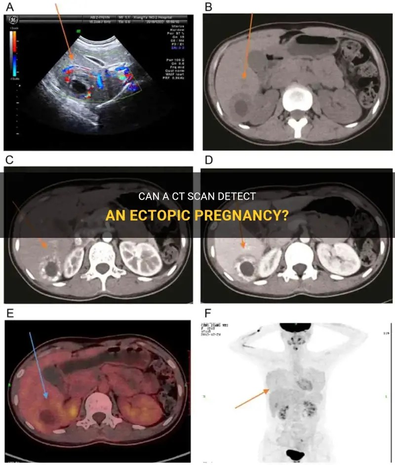 Can A Ct Scan Detect An Ectopic Pregnancy? ShunChild