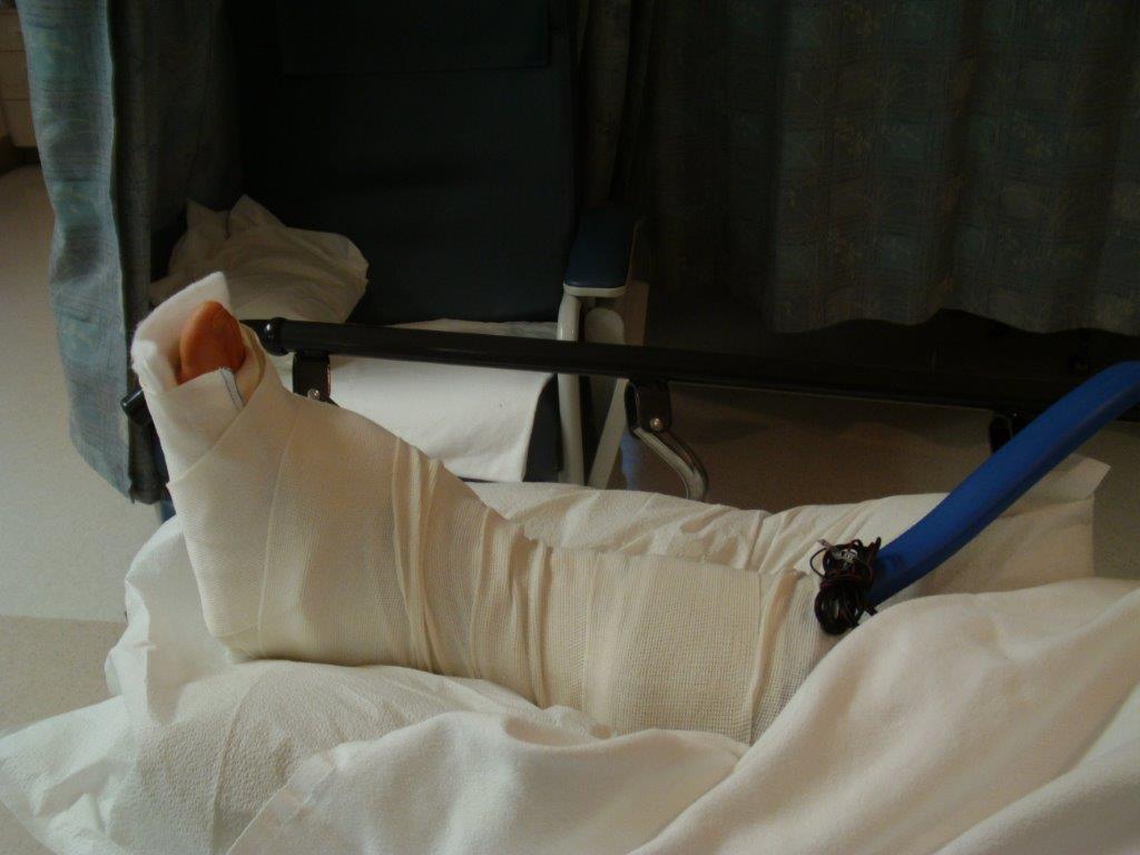 HyProCure TaloTarsal Stabilization for Subtalar Joint Recurrent Dislocation