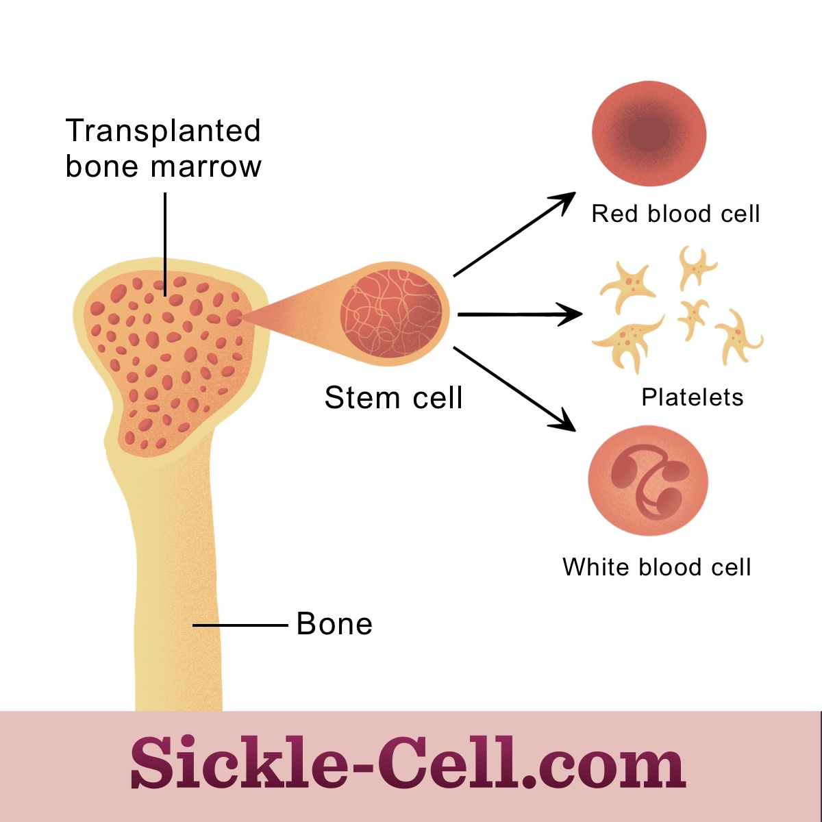 Bone Marrow Transplants for Sickle Cell Disease