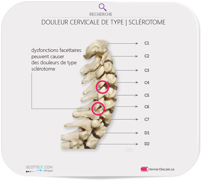 ARTHROSE CERVICALE DOULEUR AU BRAS AVEC SYMPTÔME