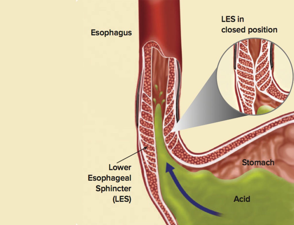 Gastroesophageal Reflux Disease (GERD) SIFSOF