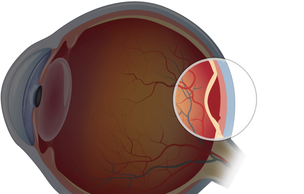 망막 박리를 위한 레이저 치료 SIFSOF