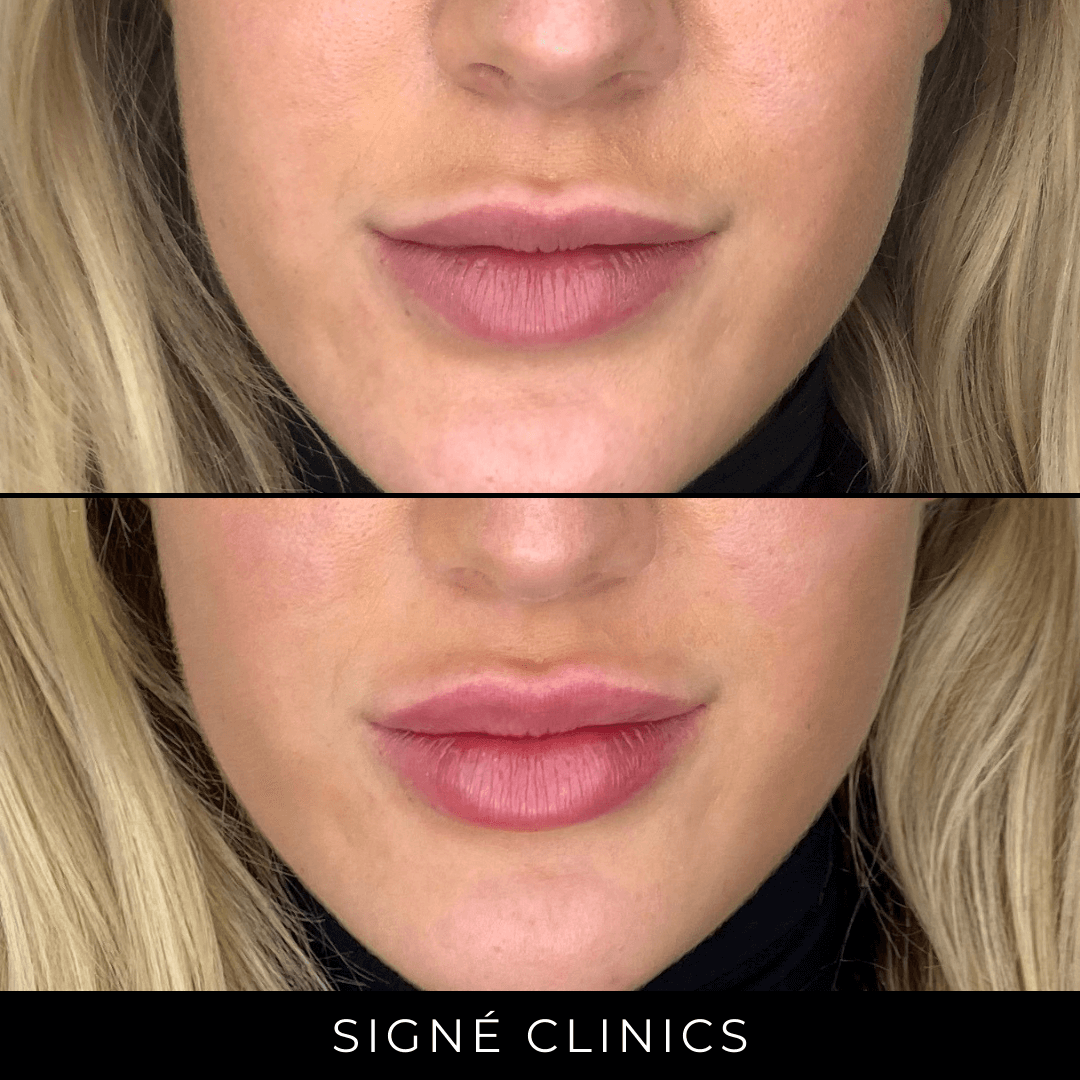 Lipfillers: Cosmetische Behandelingen Bij Signé Clinics