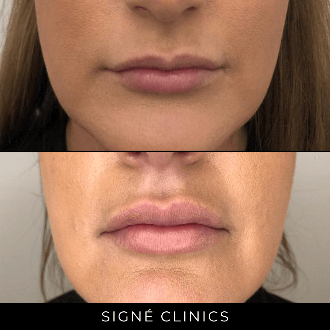 Lipfillers: Cosmetische Behandelingen Bij Signé Clinics