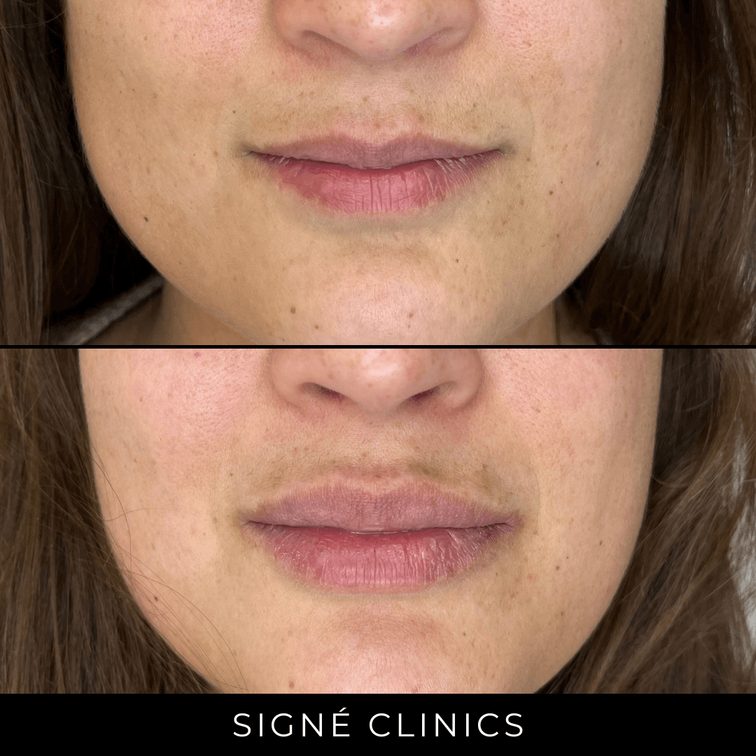 Lipfillers: Cosmetische Behandelingen Bij Signé Clinics