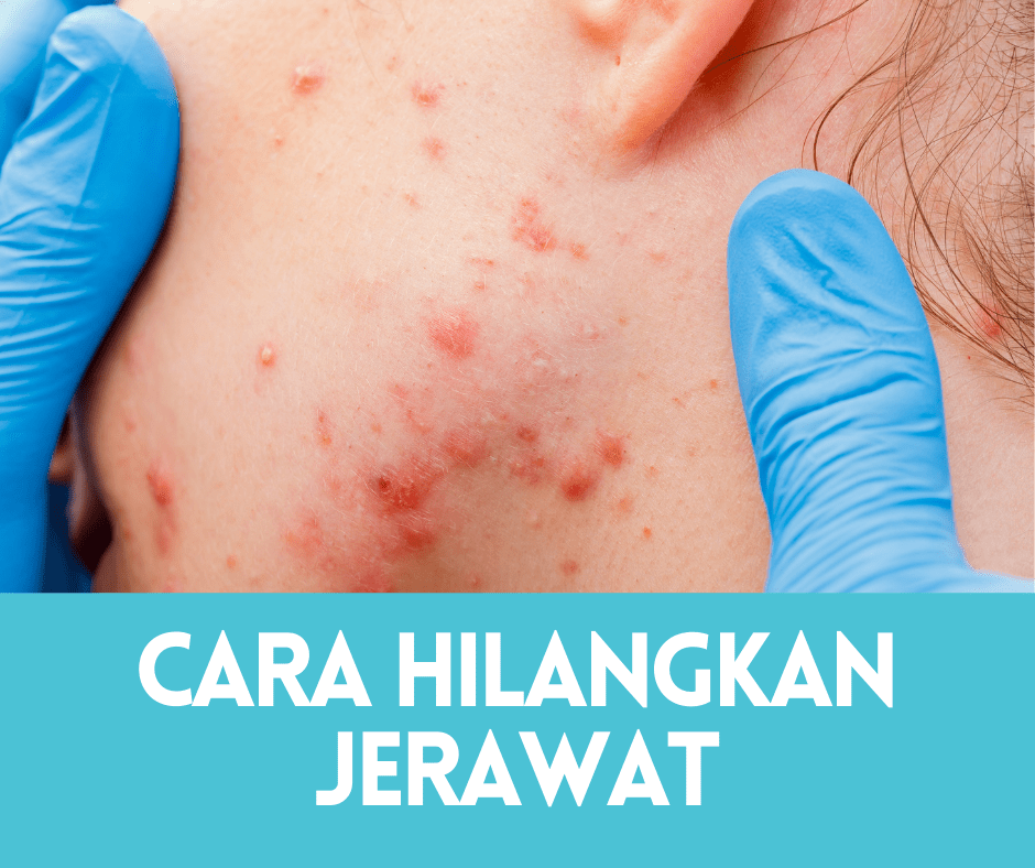 Cara Hilangkan Jerawat di Muka Dengan Keto & Intermittent Fasting (IF