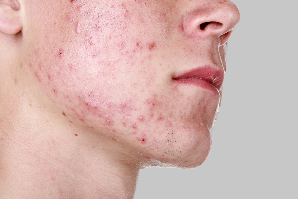 Acne Skin Concern & Treatment SILK Laser Clinics