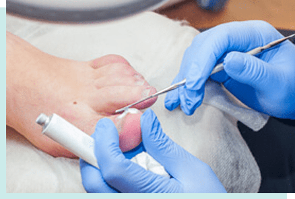 Laser Toenail Fungus Treatment Calgary Silverado Aesthetic Clinic