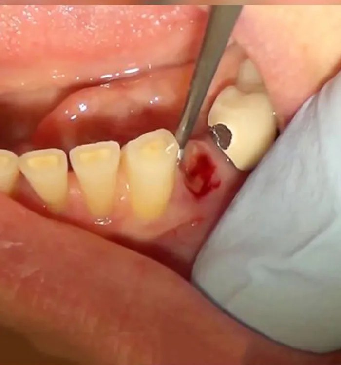 Extract Broken Root Family Dental Clinic