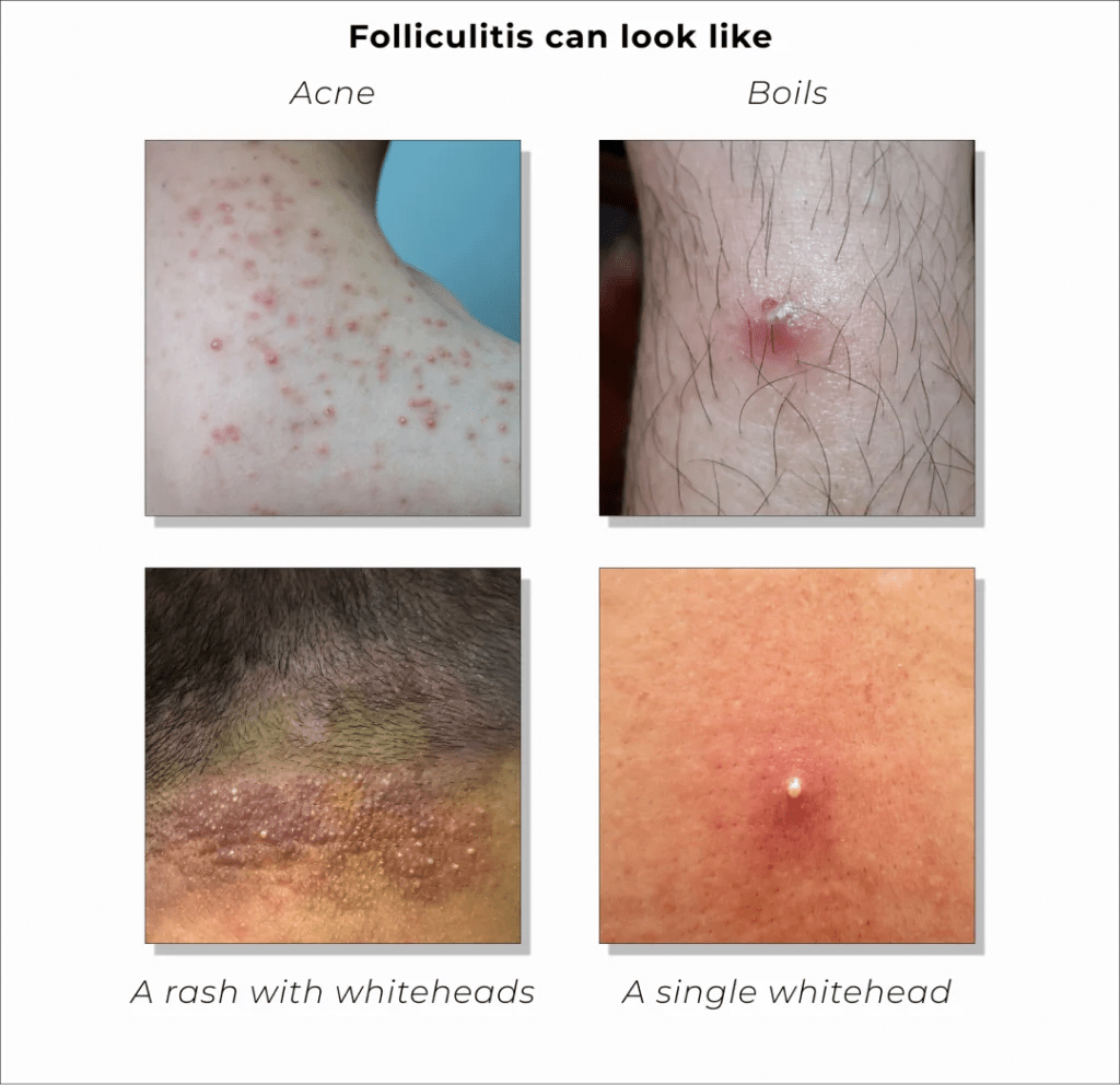 Bacterial Folliculitis Understanding Folliculitis Spectrum Health
