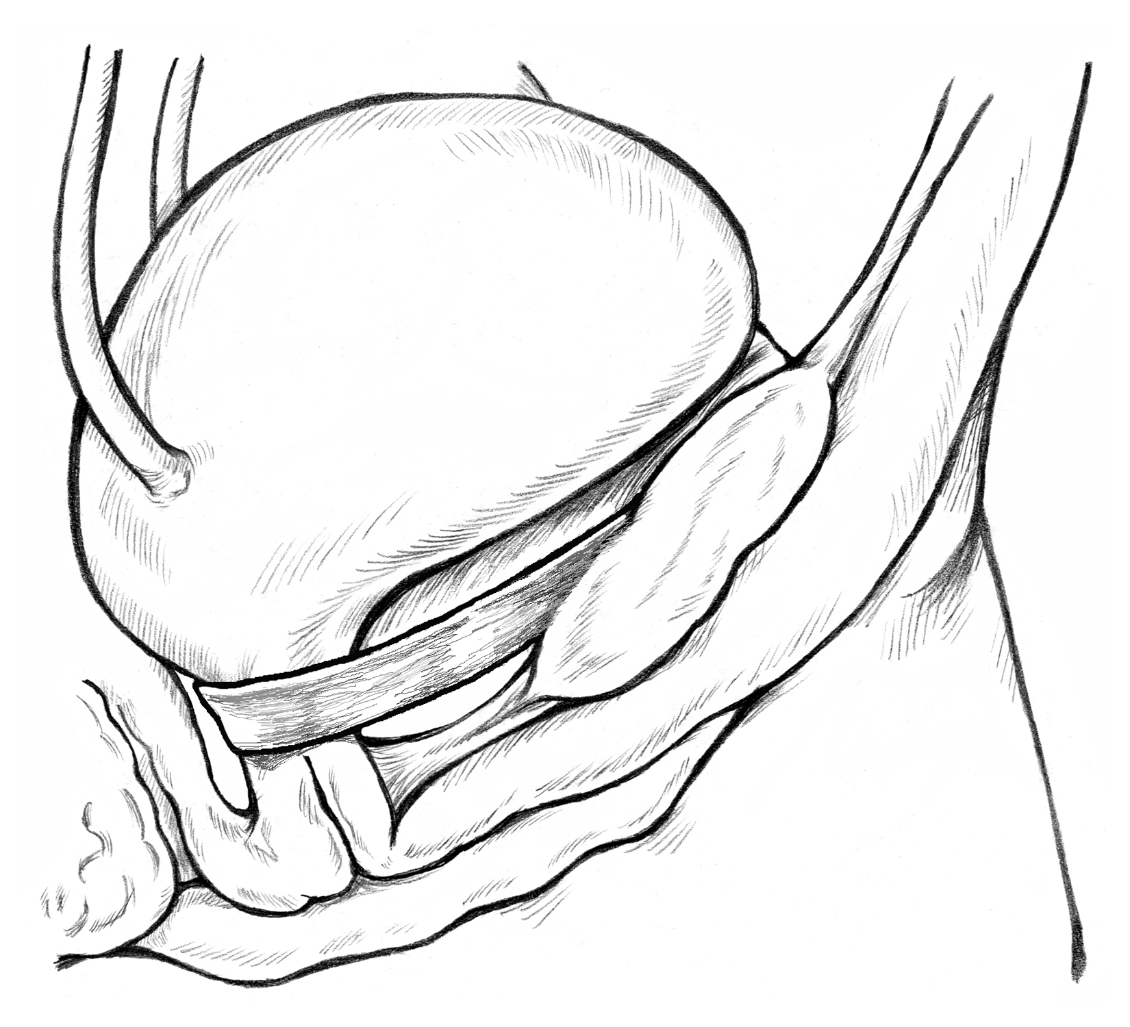 Surgeries for Stress Urinary Incontinence (SUI)