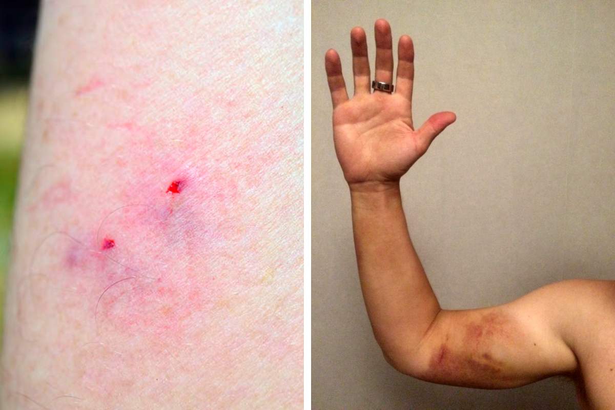 Tipos de picaduras cómo entender quién mordió Simplemente Genial