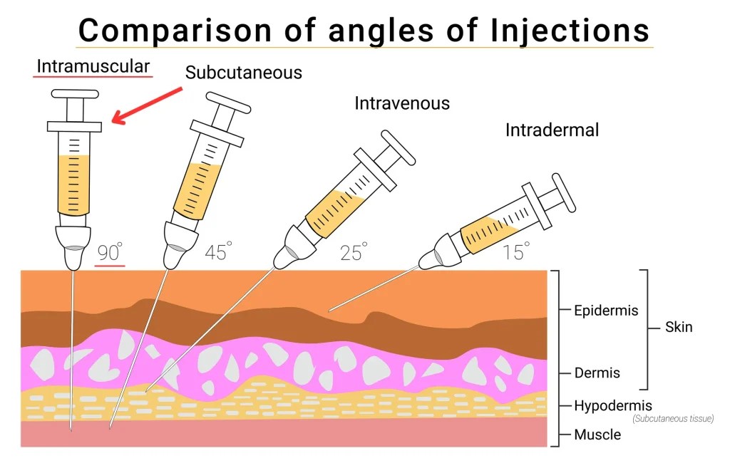 Intramuscular Injection: Sites, Techniques, and Tips