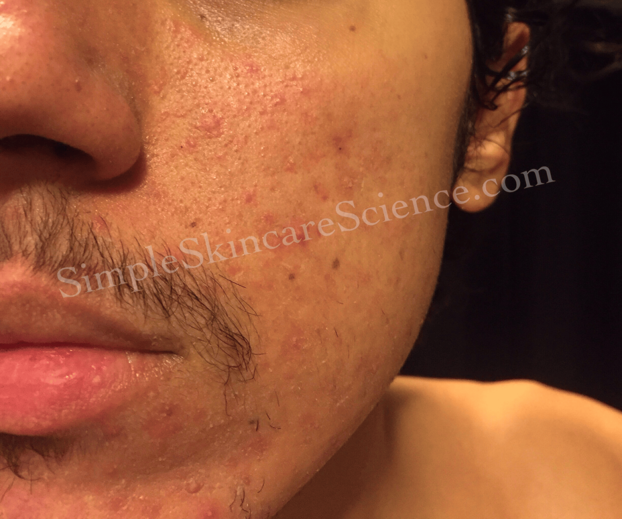 malassezia folliculitis