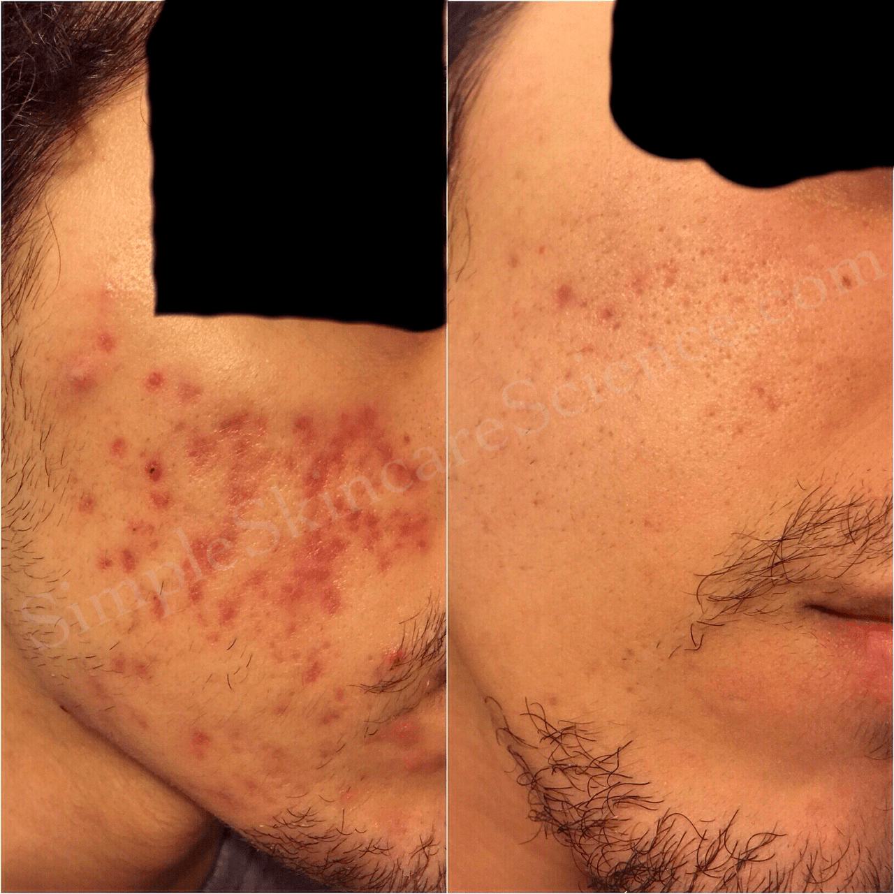 post inflammatory erythema before aftermin