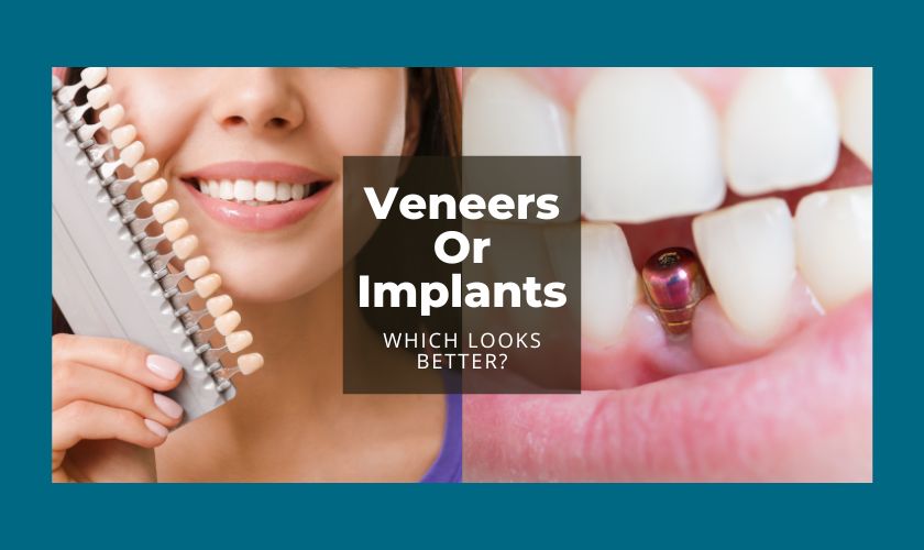 Which Looks Better, Veneers Or Implants?