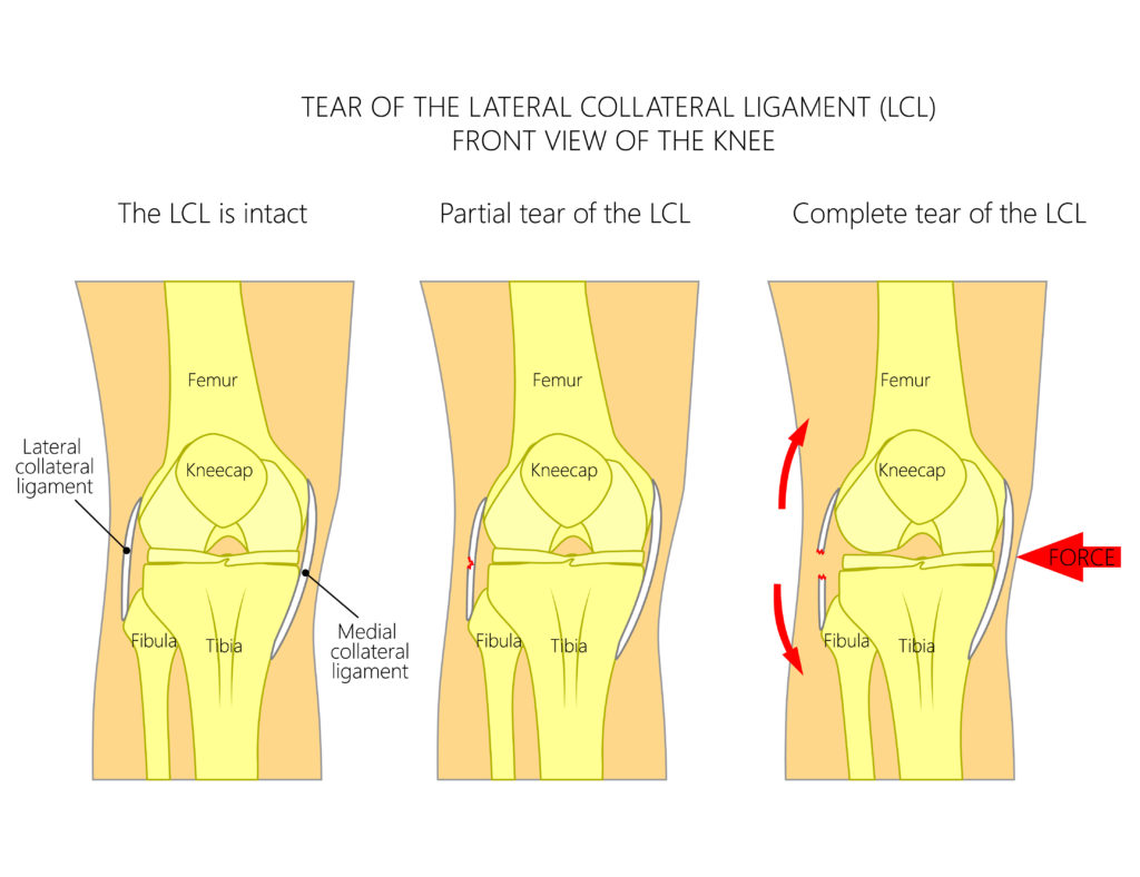 lateral Collateral Ligament Injury physio treatment toronto