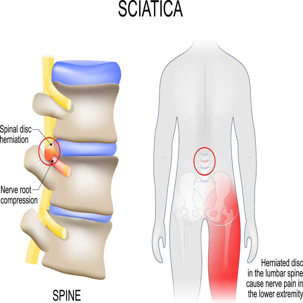 Sciatica Causes, Symptoms, Treatment & Prevention