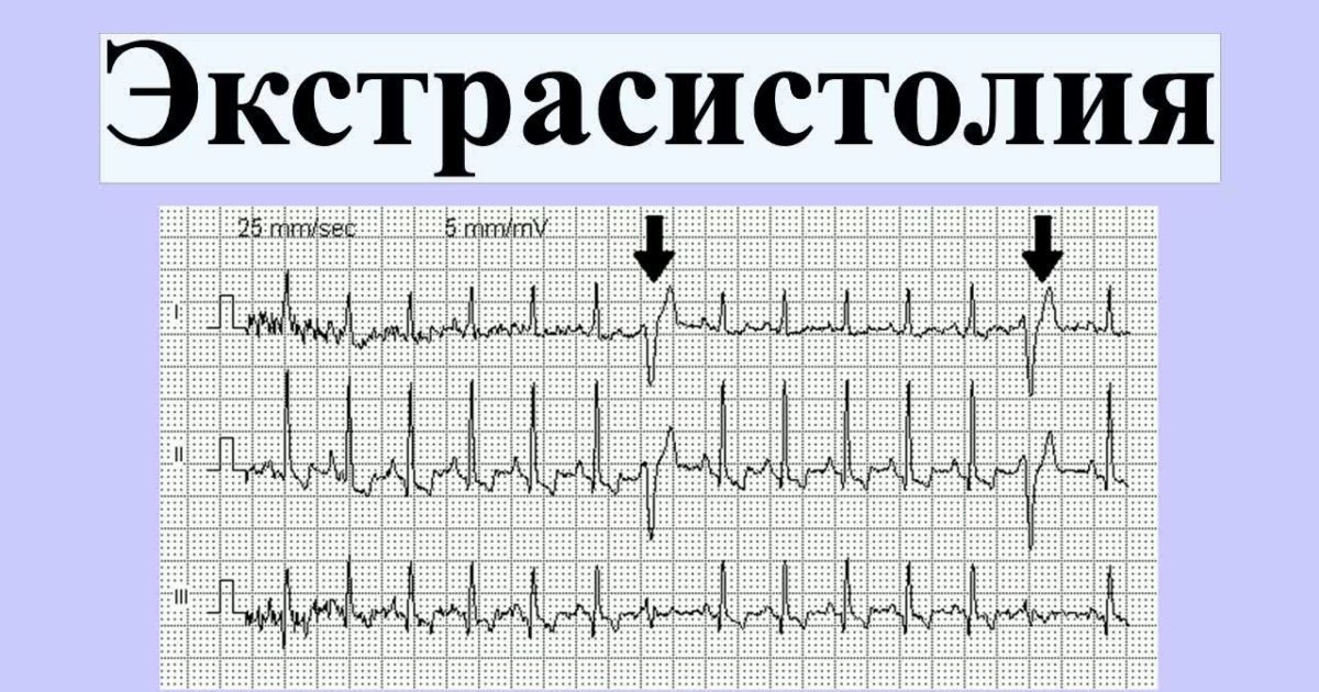 Atrial Extrasystole on the ECG All About The Heart Detonic