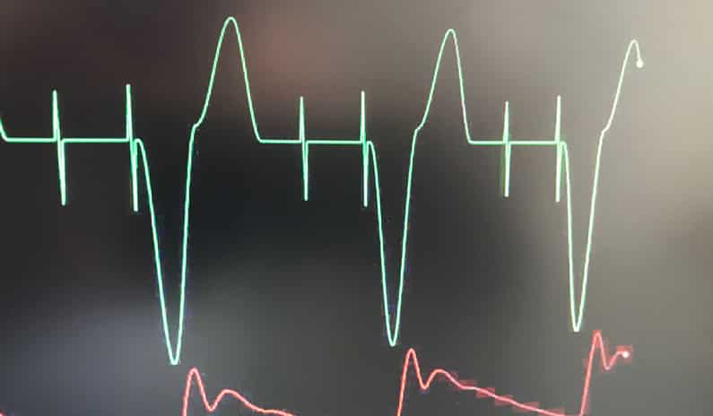 3 Gründe, die den EKG und Schrittmacher Notfallkurs einzigartig machten