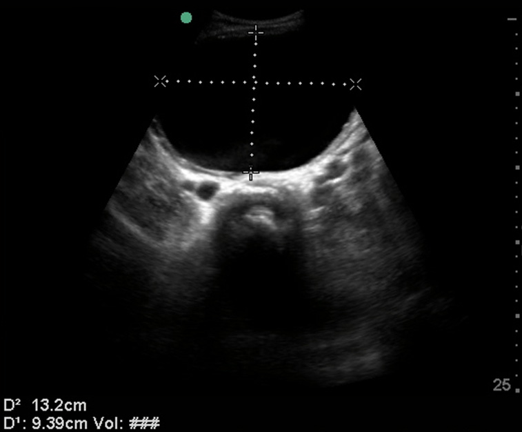 Kidney SinaiEM