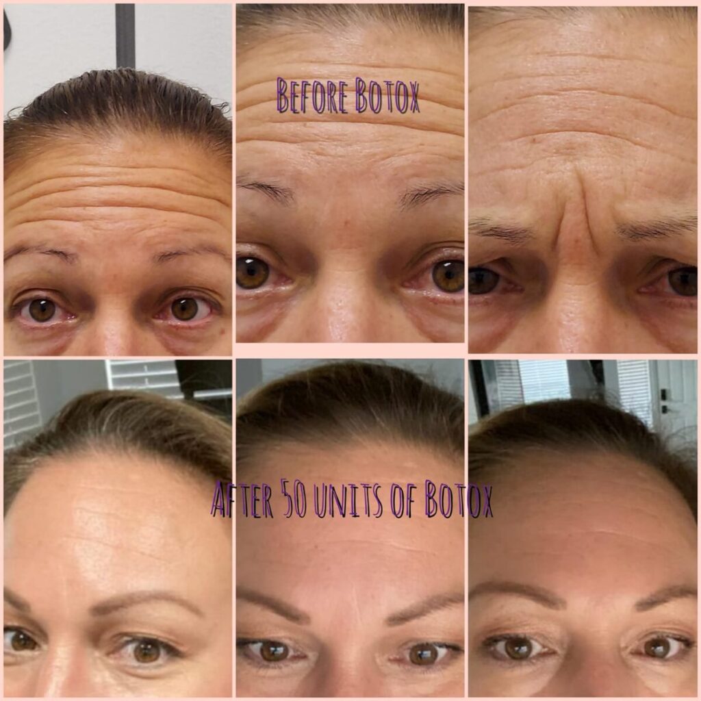 Non Surgical Wrinkle Treatments in Las Vegas Cosmetic Fillers