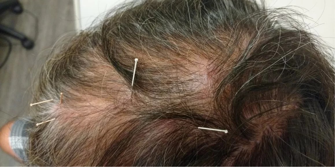 TCM Treatments - Sin Kang TCM