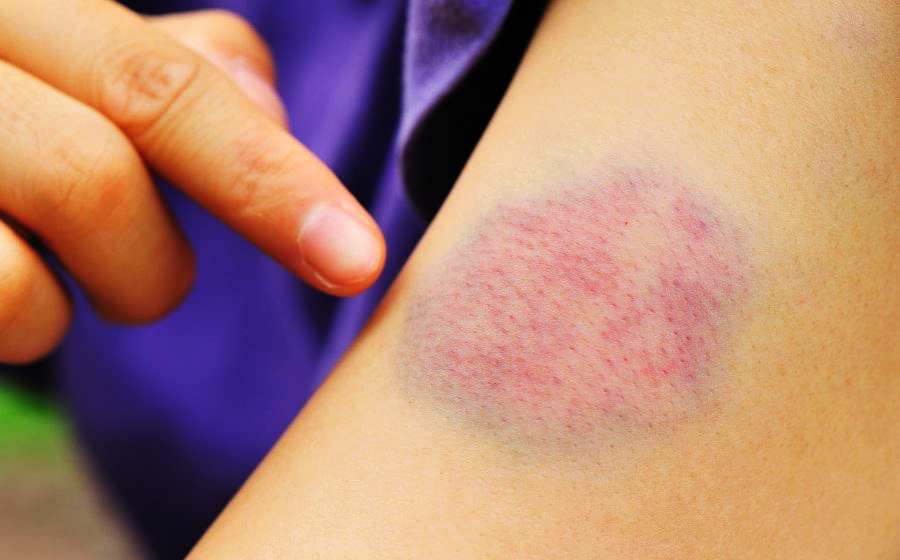 How to get rid of a bruise in 3 days Vietnamese online shop