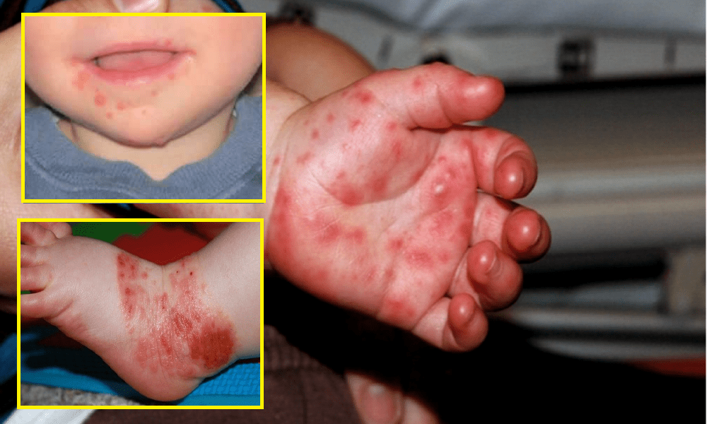 Troli Dan Mainan Di Pasaraya Salah Satu Punca HFMD Tersebar