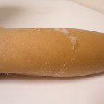 頭皮の日焼けの皮むけ期間は フケみたいな皮むけの対処方法は