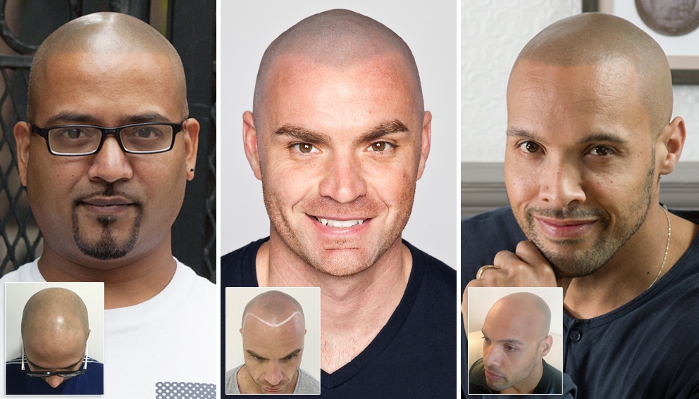 Frequently Asked Questions Head Tattoos FAQ Skalp®