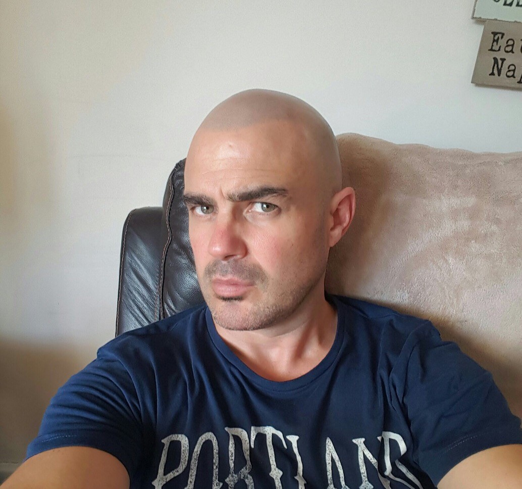 Hair Loss Cure Recent results at Skalp® Manchester Hair Loss Cure Recent results at Skalp® Manchester