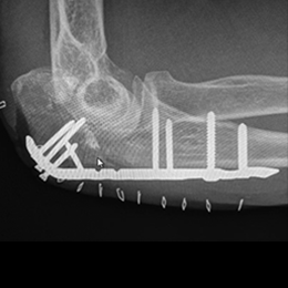Proximal Ulna Plate - Skeletal Dynamics