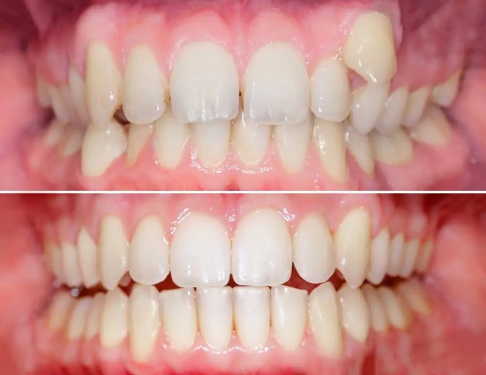 Orthodontic Treatment in Dubai, UAE Orthodontist in Dubai Skin111