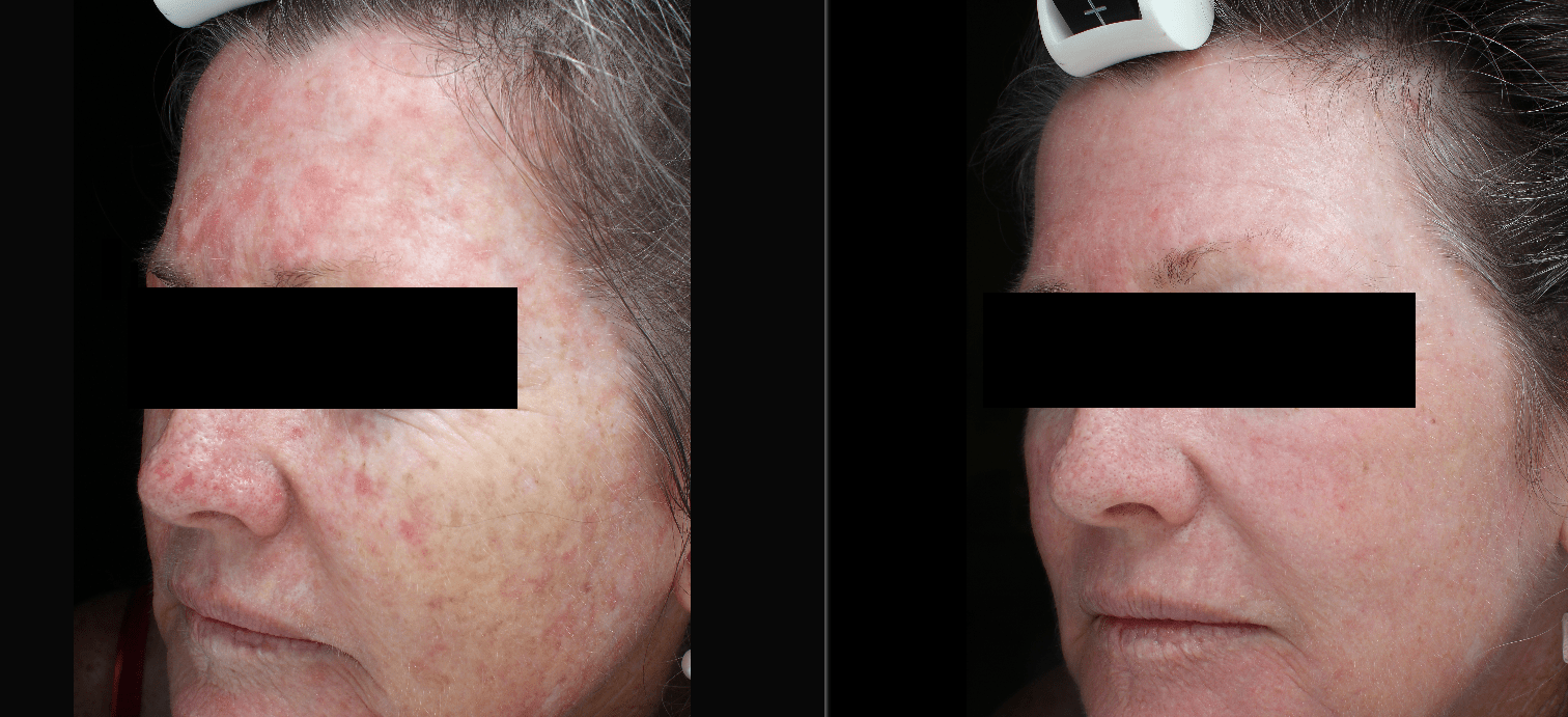 PhotoDynamic Therapy Skin Alert Cairns Skin Cancer and Cosmetic Clinic