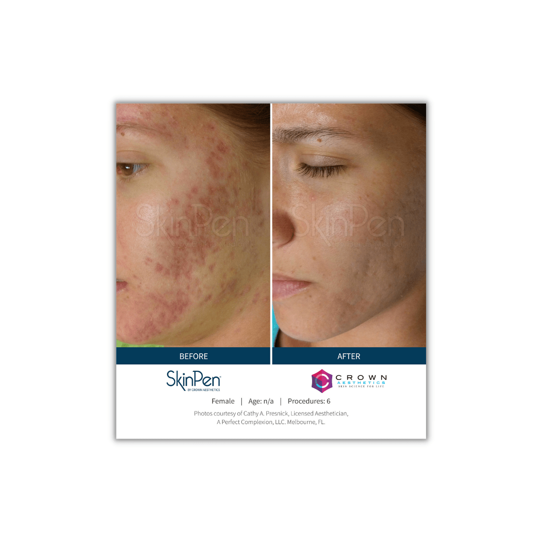 SkinPen® The GoldStandard in Microneedling Skin Artisans