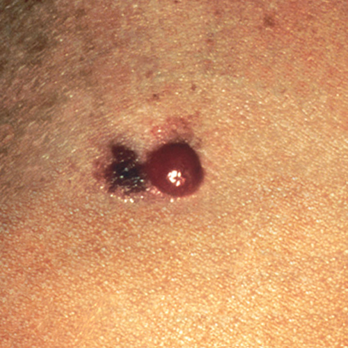 What Does Melanoma Look Like?