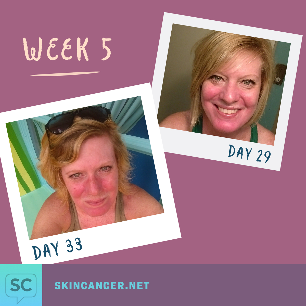 My Efudex Photo Journey Topical Chemotherapy