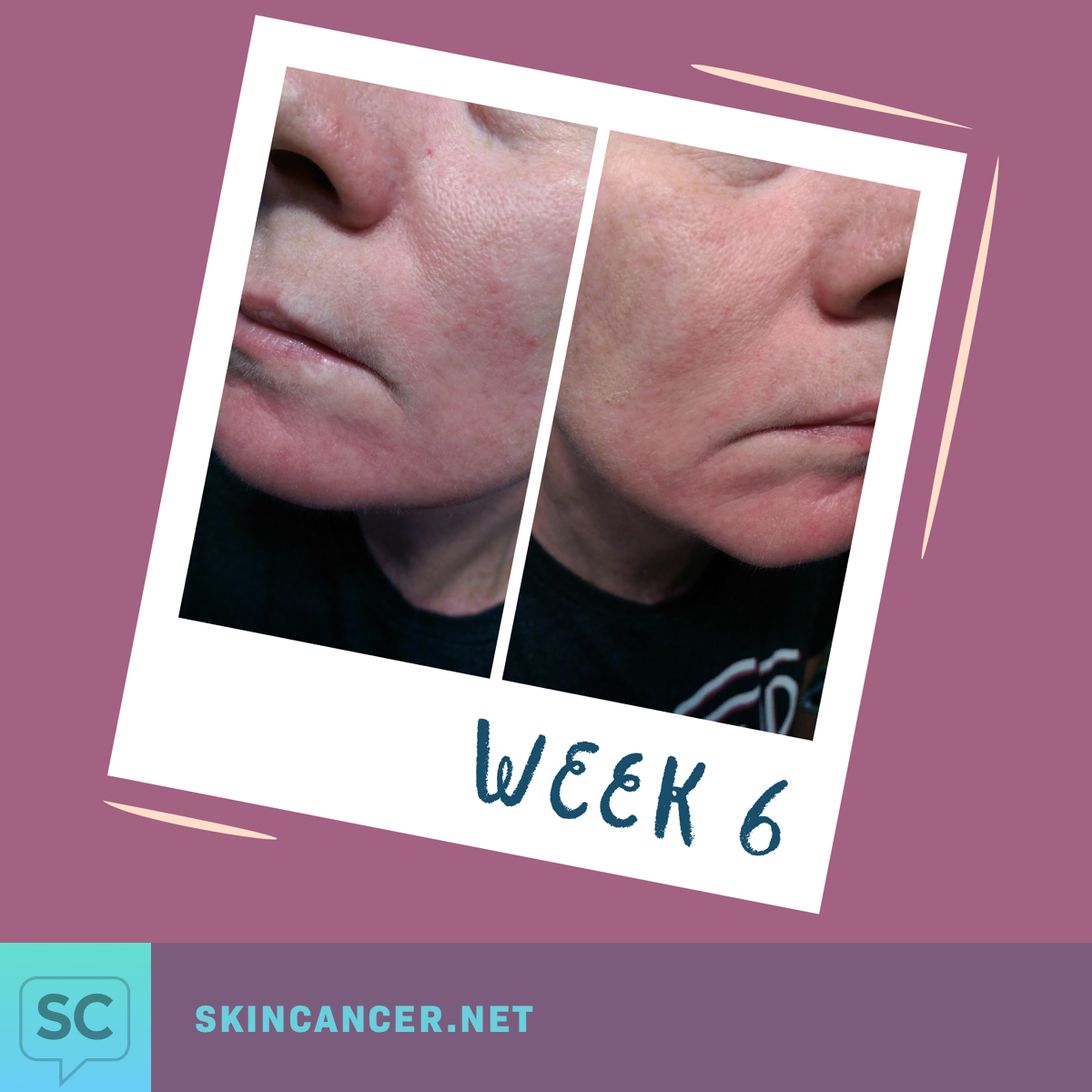 My Efudex Photo Journey Topical Chemotherapy