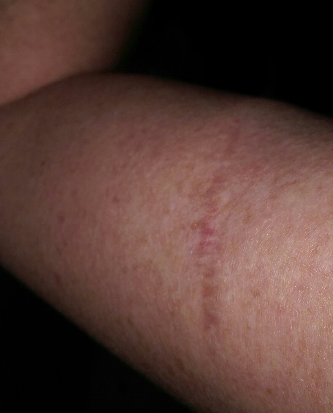 Skin Cancer Spots On Arm