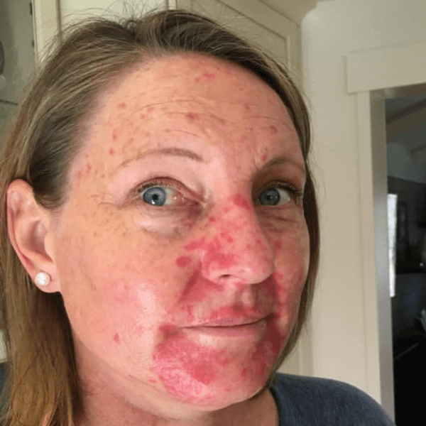 Efudex and Topical Chemotherapy Images for Skin Cancer