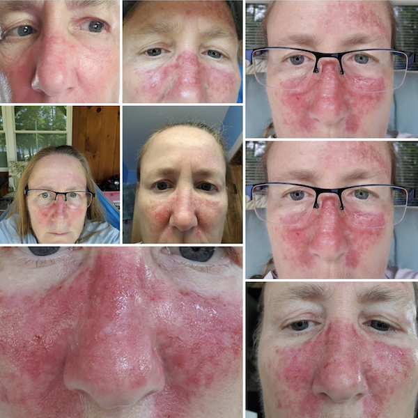 Efudex and Topical Chemotherapy Images for Skin Cancer