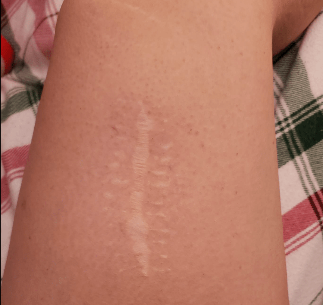 Skin Cancer Scars Images