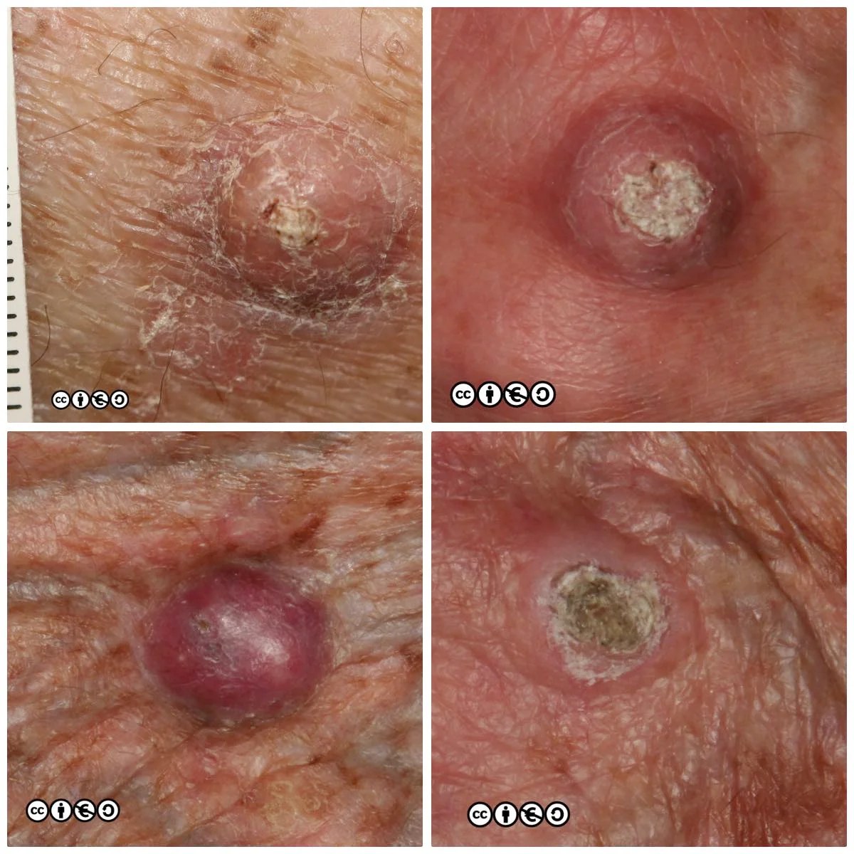 Squamous Cell Skin Cancer Types