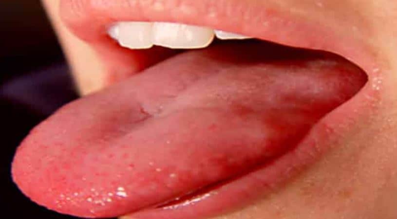 Why Pimples on Tongue Side, Under, Tip, Side or Back Skincarederm