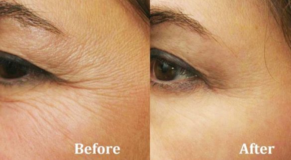 Tips and Ways to Remove Wrinkles Under Eyes and Skin Skincarederm