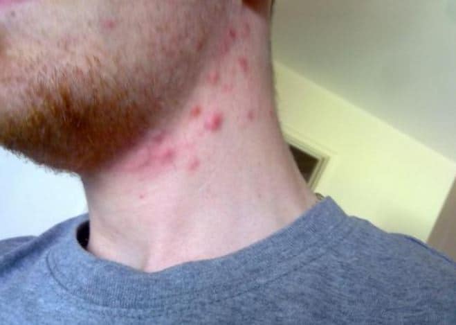 Healing Pimples on Neck Front, Back, Chin and Cheeks Skincarederm
