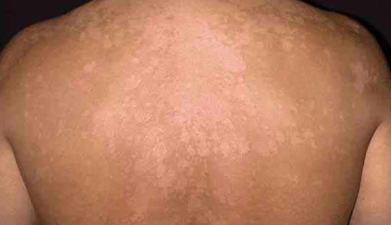 Dry or White Patches on Skin Causes and Treatments Skincarederm