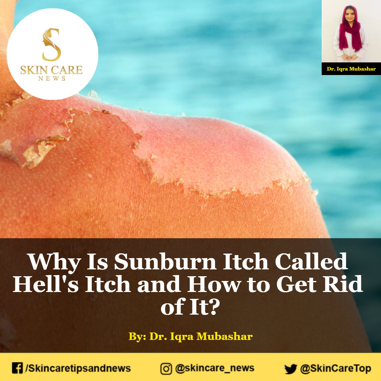 Why Is Sunburn Itch Called Hell's Itch and How to Get Rid of It?