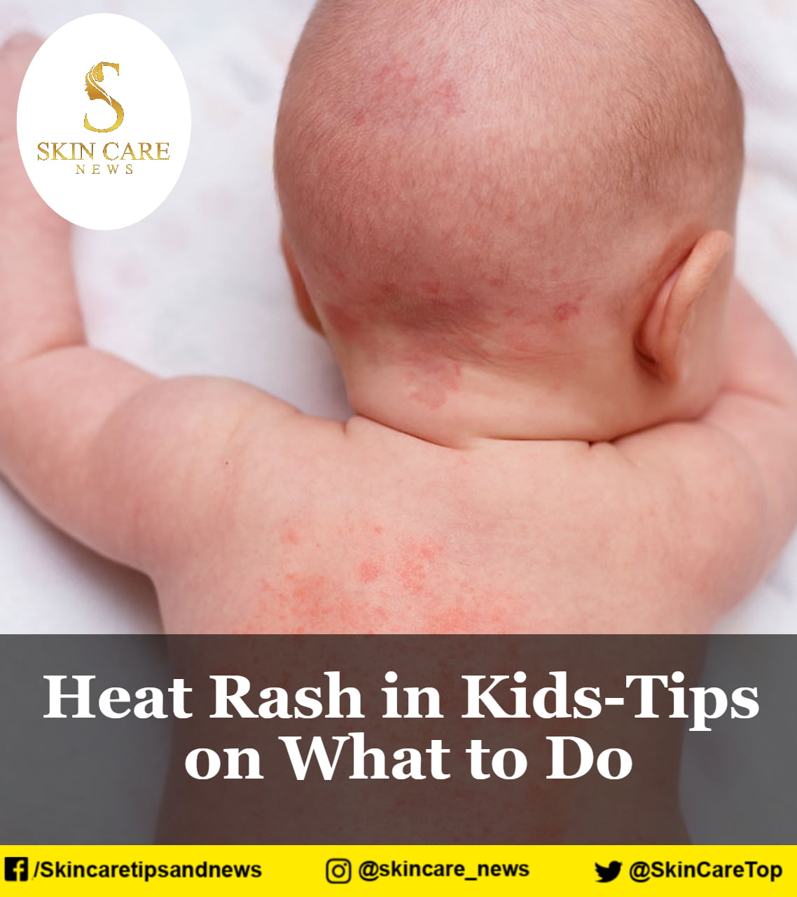 Heat Rash in KidsTips on What to Do